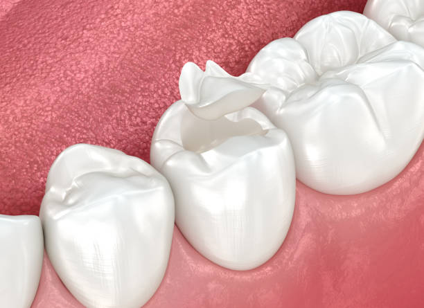 Dental Bonding in River Ridge, FL